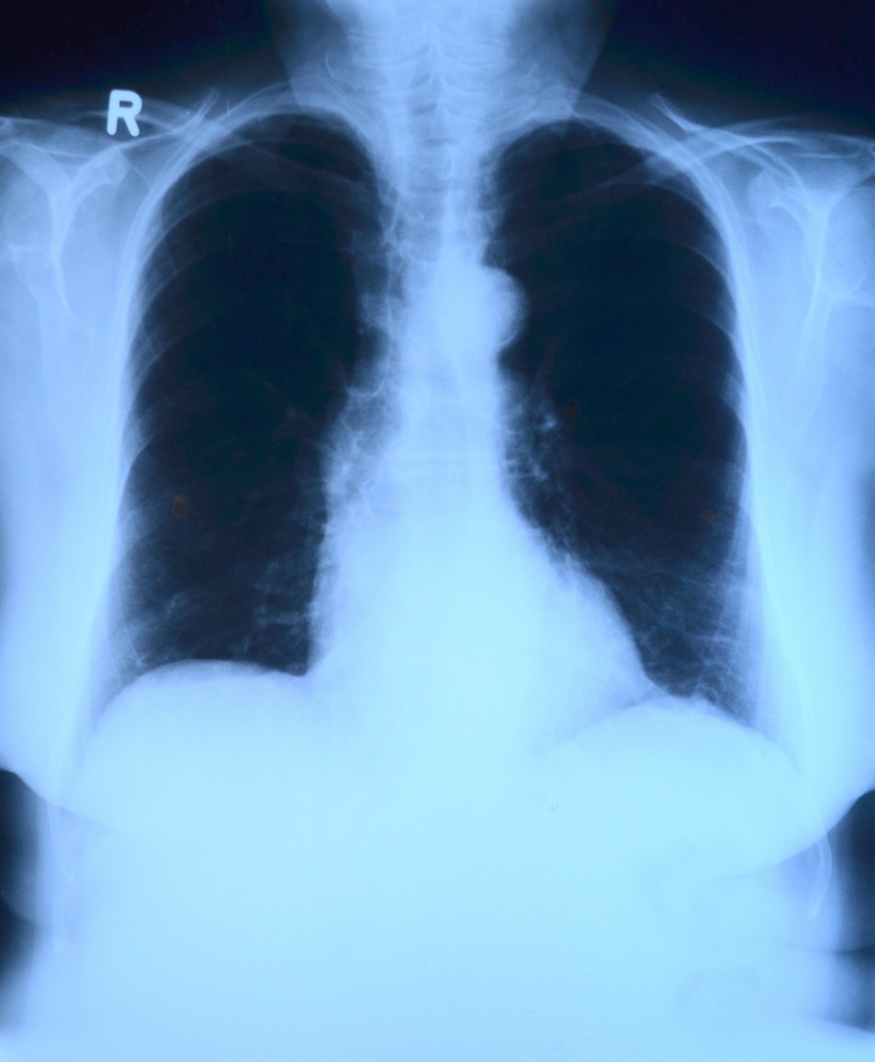 Do I Have a Case if My Doctor Failed to Diagnose Lung Cancer?