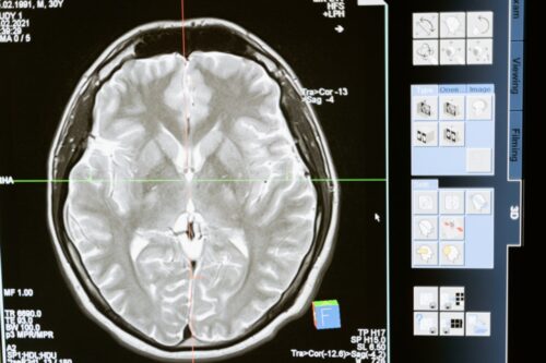 x-ray scan brain